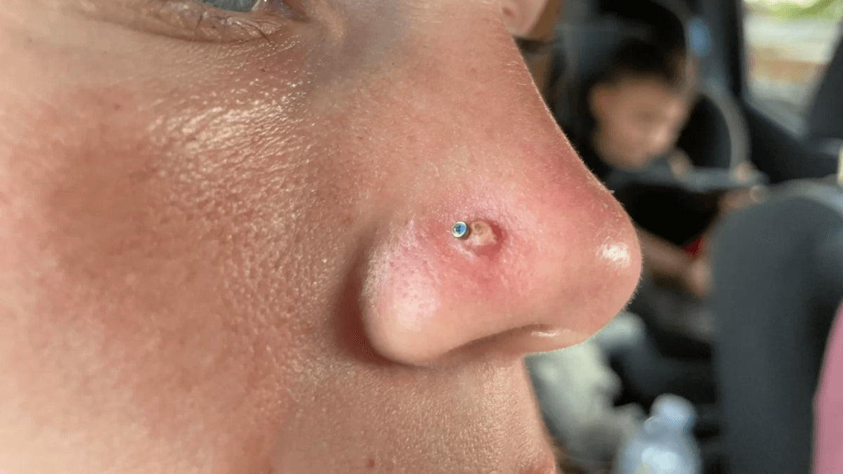 Granuloma, Bultos en tu Piercing